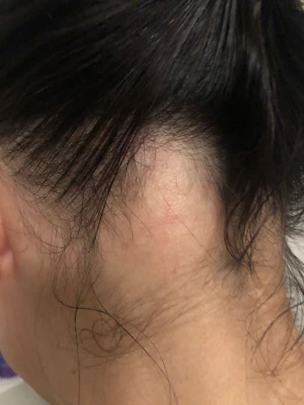 beautybyash bold spot kale plek alopecia haar